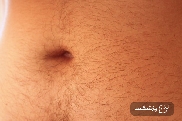 عفونت ناف