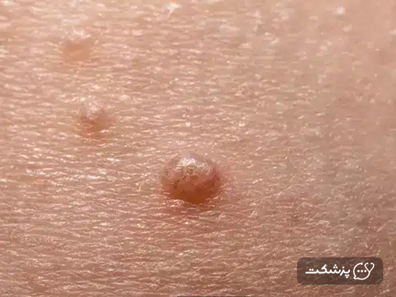توده های اطراف ناف