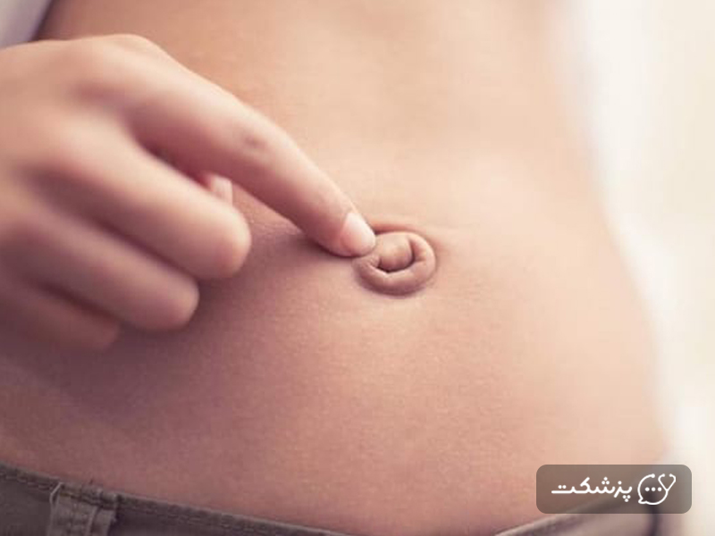 علت عفونت ناف