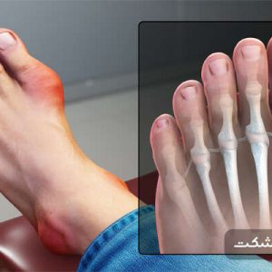 تصویر غضروف ملتهب بیمار مبتلا به نقرس
