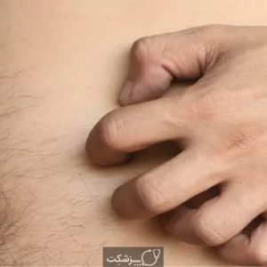 شایع ترین علل خارش شکم-پزشکت