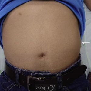 توده در قسمت پایین و چپ شکم | پزشکت