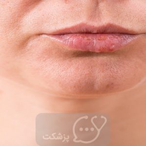 رآمدگی سفید روی لب | پزشکت
