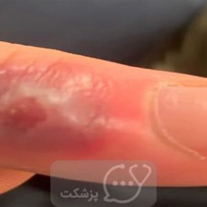 عفونت انگشت || پزشکت