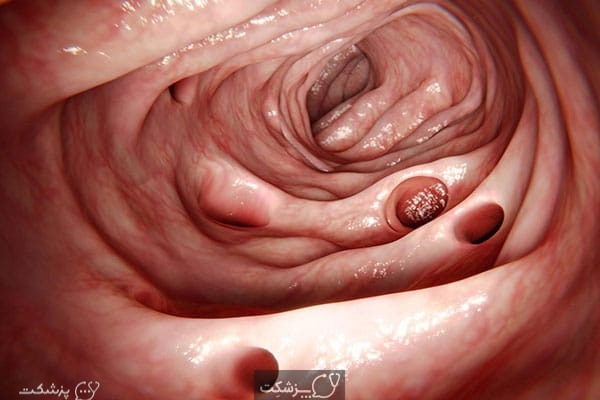 کولیت با غشای کاذب  | پزشکت