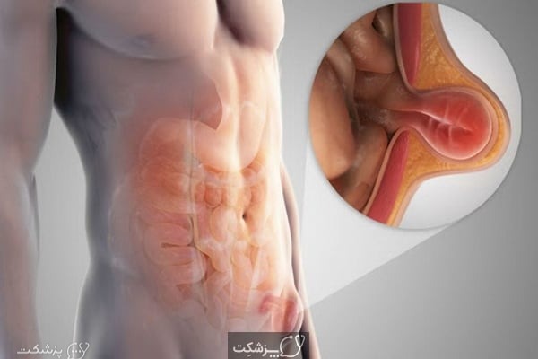 ورم غدد لنفاوی کشاله ران | پزشکت