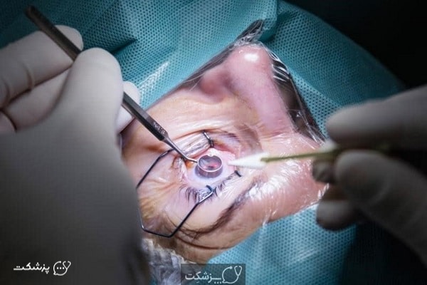 پیوند قرنیه || پزشکت