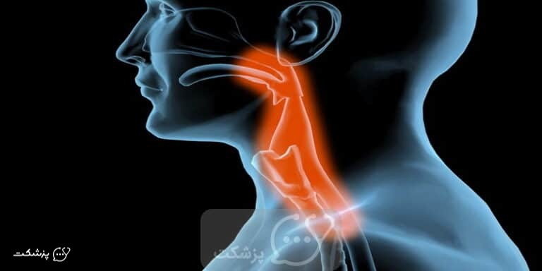 تنگی خوش خیم مری چیست؟ || پزشکت