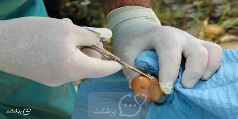 جراحی فرو رفتن ناخن در گوشت || پزشکت