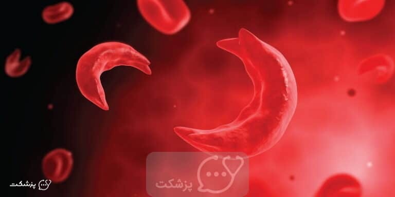 پویکیلوسیتوز | پزشکت