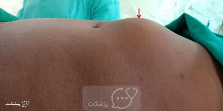 فتق اپی گاستر چقدر خطرناک است؟ || پزشکت