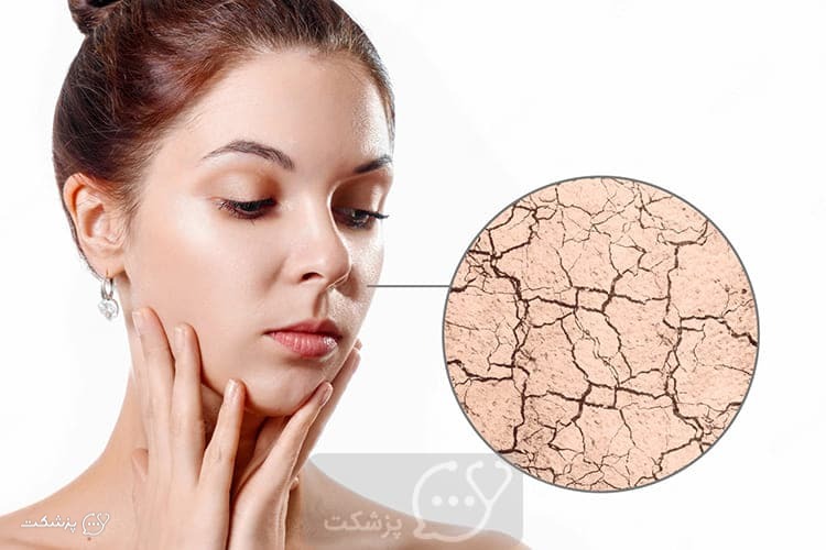 روغن برای افزایش رطوبت پوست خشک || پزشکت