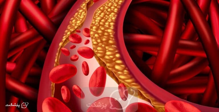 بیماری های شریانی || پزشکت