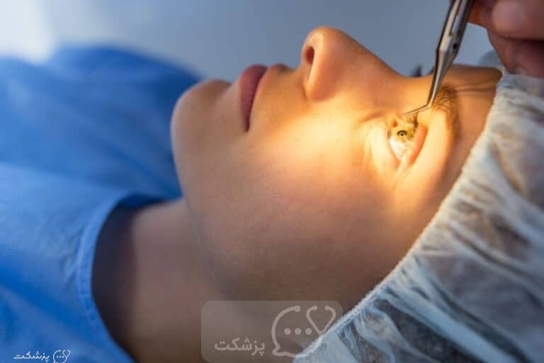 سندرم فلاپی عنبیه حین عمل || پزشکت