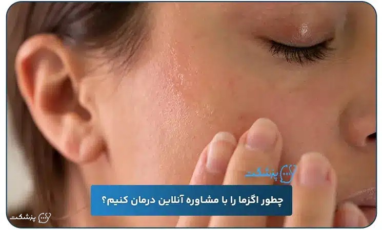 چطور اگزما را با مشاوره آنلاین درمان کنیم؟ | پزشکت